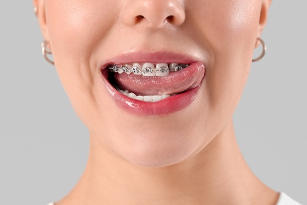 Who Is A Good Candidate For Braces For Adults?