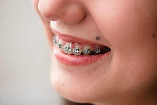 The Key Advantages Of Orthodontist Led Teeth Straightening